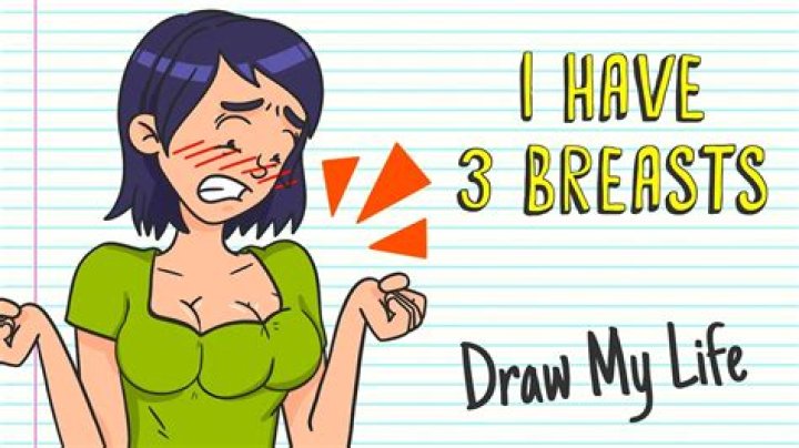 Understanding the Rare Condition of Having Three Breasts: A Comprehensive Guide