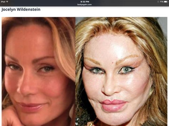 Bad Celebrity Plastic Surgery: A Cautionary Tale