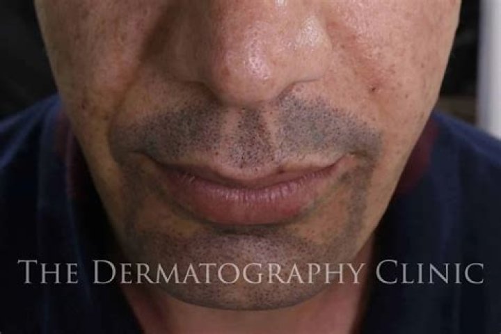 Beard Tattoo: The Ultimate Guide to Beard Tattoos and Their Popularity