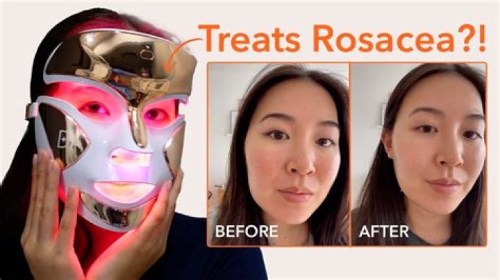 Best Mask for Rosacea: The Ultimate Guide to Soothe and Protect Your Skin