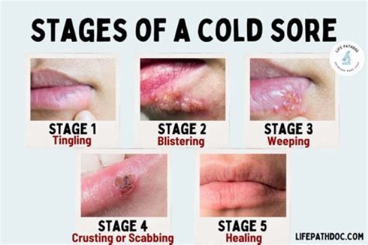 Can You Bust a Cold Sore? Comprehensive Guide to Managing and Treating Cold Sores