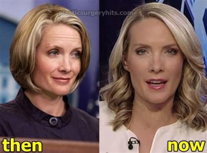 Get the Scoop: Dana Perino's Nose Analysis and Enhancements