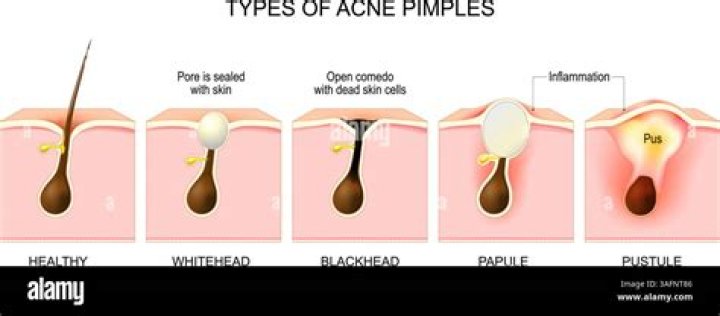 Deep Blind Pimple Diagram: Your Ultimate Guide to Understanding and Treating Stubborn Blemishes