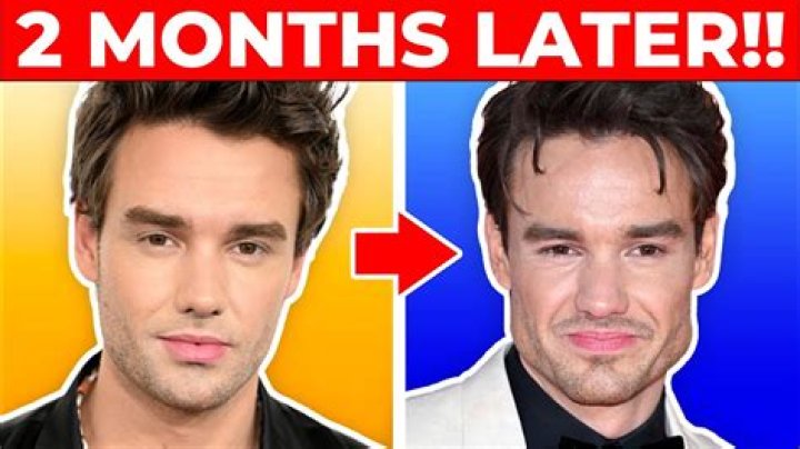 Uncovering the Truth: Did Liam Payne Have Surgery on His Face?