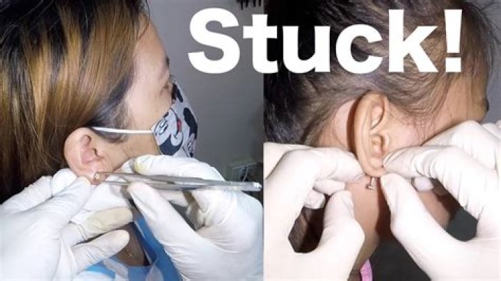 Earring Back Stuck in Earlobe: Causes, Solutions, and Prevention