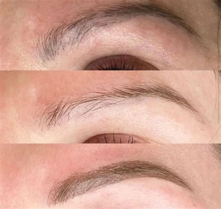 Eyebrow Tattoo Removal Cost: A Comprehensive Guide to Pricing, Options, and Considerations