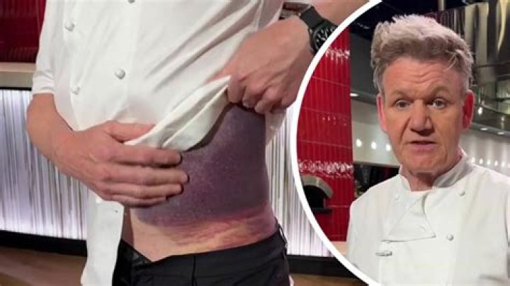 Understanding Gordon Ramsay's Bruise: What It Means and How It Affects His Career