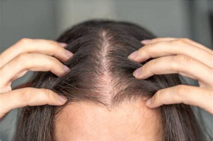 Hair Loss and Emaglutide Side Effects: A Comprehensive Guide