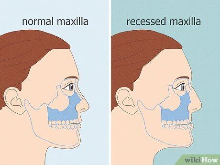 How to Tell If You Have a Recessed Maxilla: A Comprehensive Guide