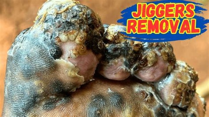 Effective Jiggers Removal: A Complete Guide to Elimination and Prevention