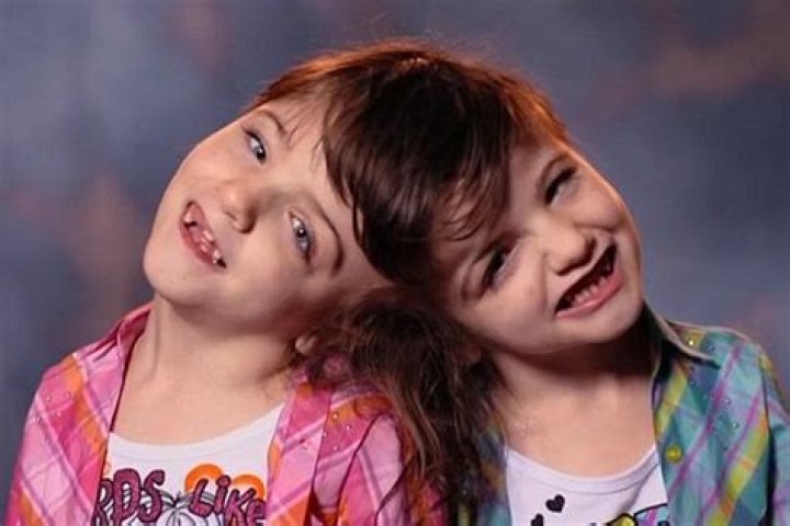 Krista and Tatiana Hogan: The Incredible Story of Conjoined Twins
