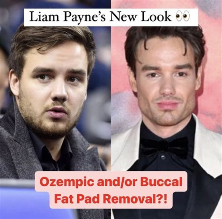 Liam Payne's Journey: The Truth Behind His Jawline Surgery