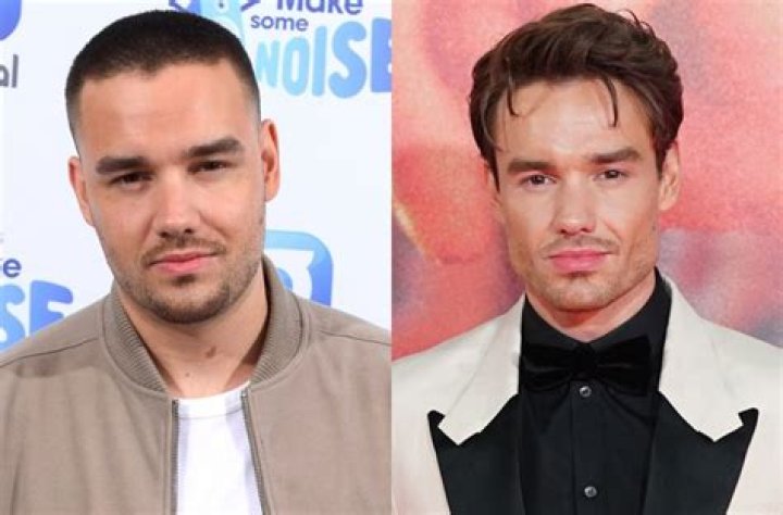 Liam Payne's Nose Job: The Transformation of a Pop Idol