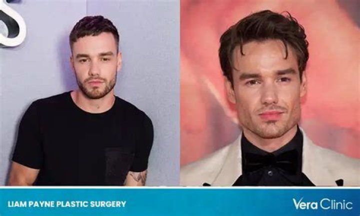 Liam Payne: The Transformation Journey through Plastic Surgery