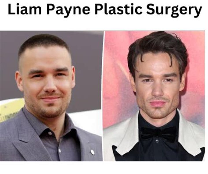Inside Liam Payne's Journey: The Story Behind His Surgery