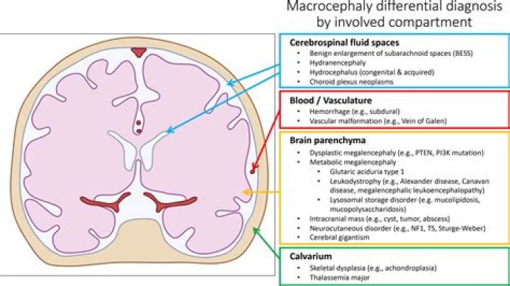 Macrocephaly Treatment: Understanding and Managing Enlarged Head Circumference