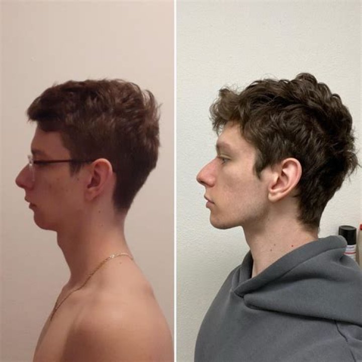 Mewing Before and After: Transform Your Facial Structure Naturally