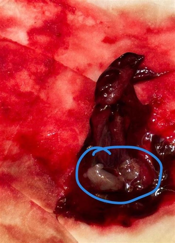 Miscarriage Tissue Pictures 6 Weeks: Understanding the Process and Seeking Support