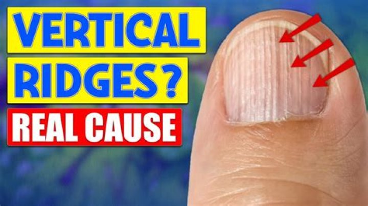 Nail Vertical Ridges: What They Are and How to Manage Them