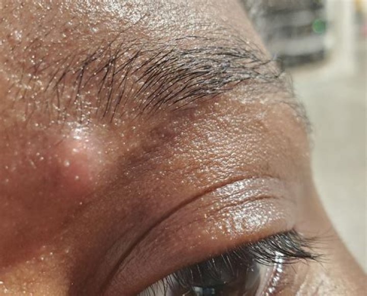 Painful Pimple on Eyebrow: Causes, Treatments, and Prevention