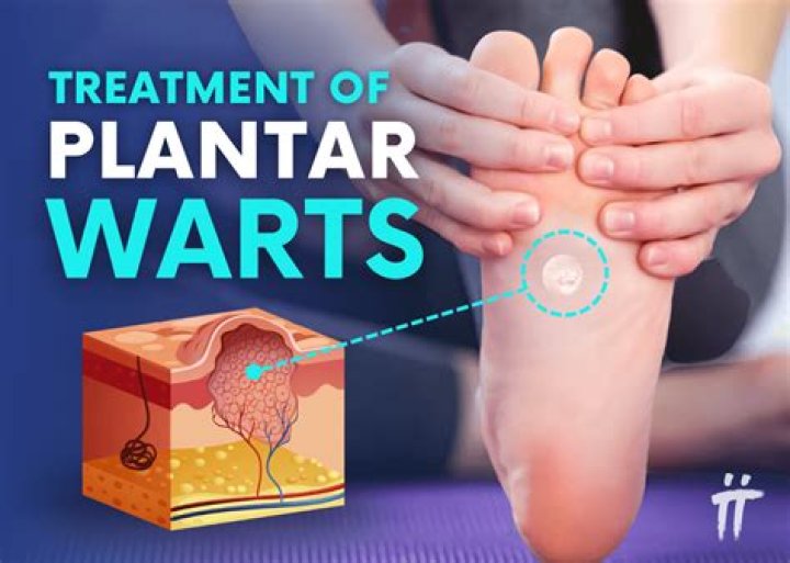 Pulled Out Plantar Wart Root: Understanding, Treatment, and Prevention