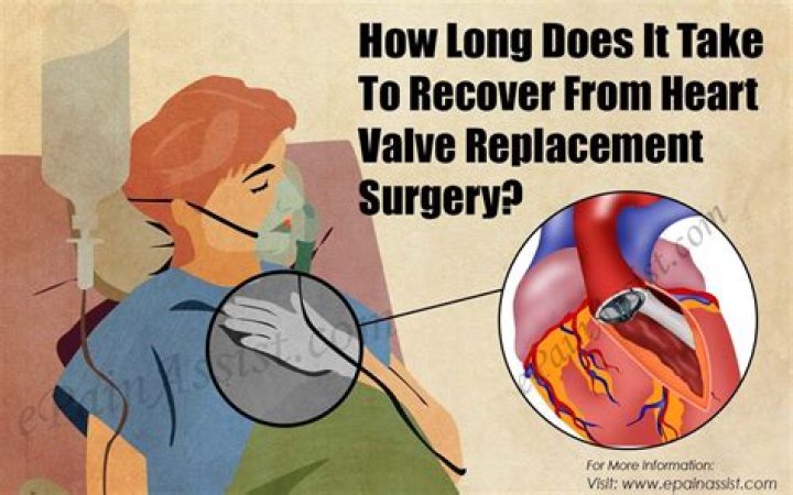 Recovery from Mitral Valve Repair: A Comprehensive Guide to Healing