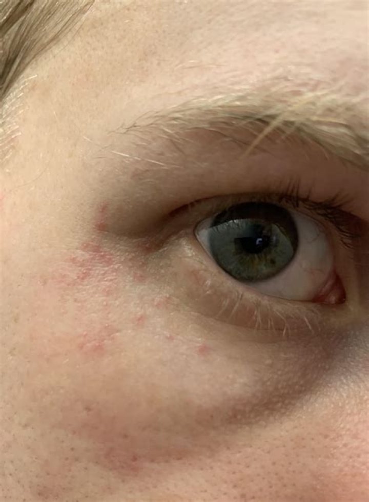 Understanding and Treating Red Bumps Under Your Eye: A Comprehensive Guide
