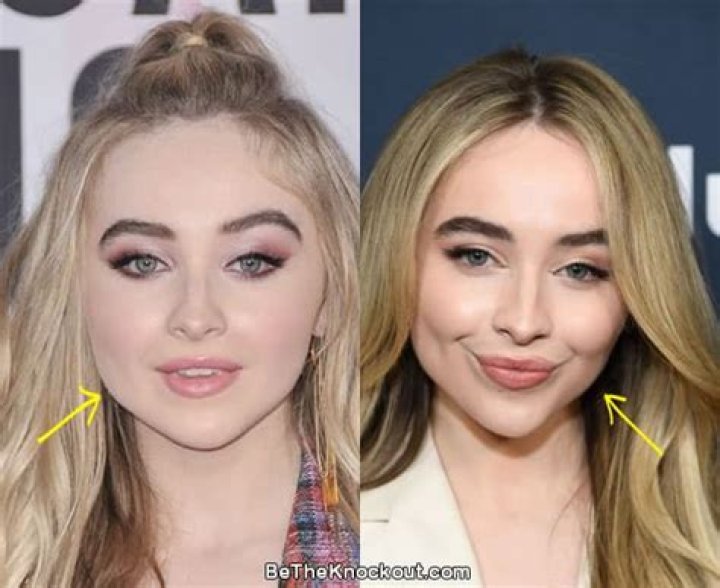 Sabrina Carpenter and the Botox Buzz: What You Need to Know