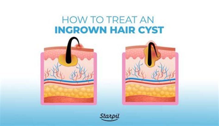 Treating Ingrown Hair Cyst: Comprehensive Guide to Managing and Preventing This Common Skin Condition