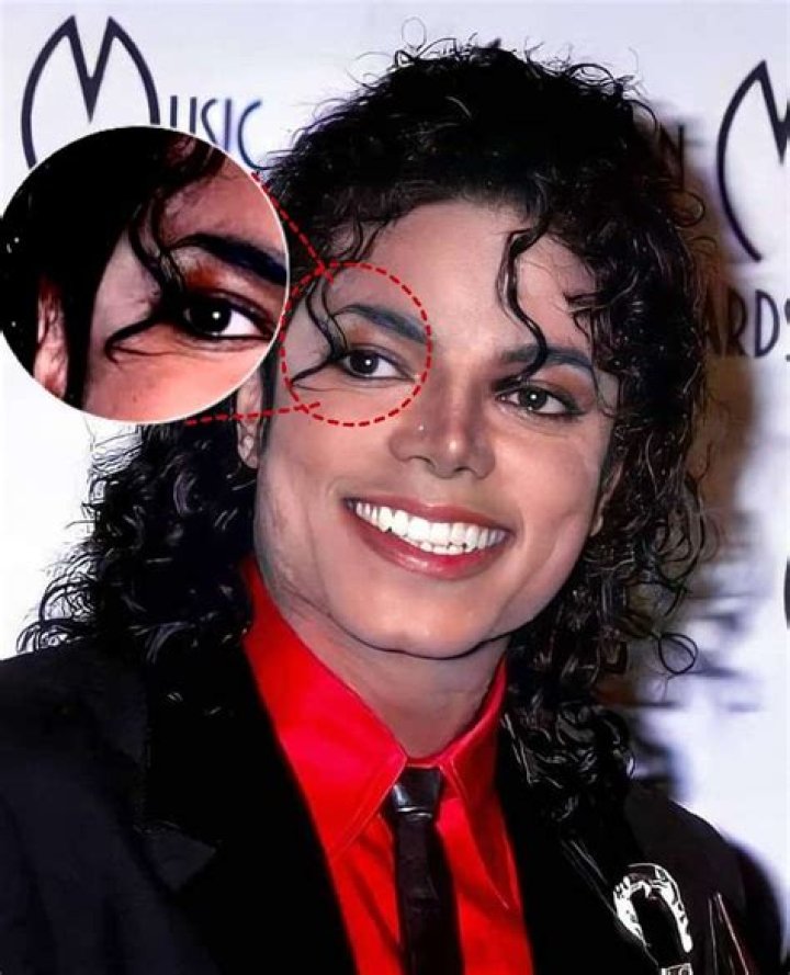 Michael Jackson's Vitiligo: Unveiling the Truth Behind His Skin Condition